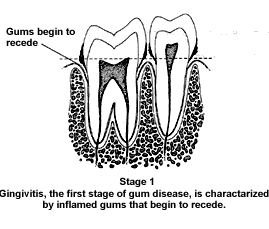 Gum Disease